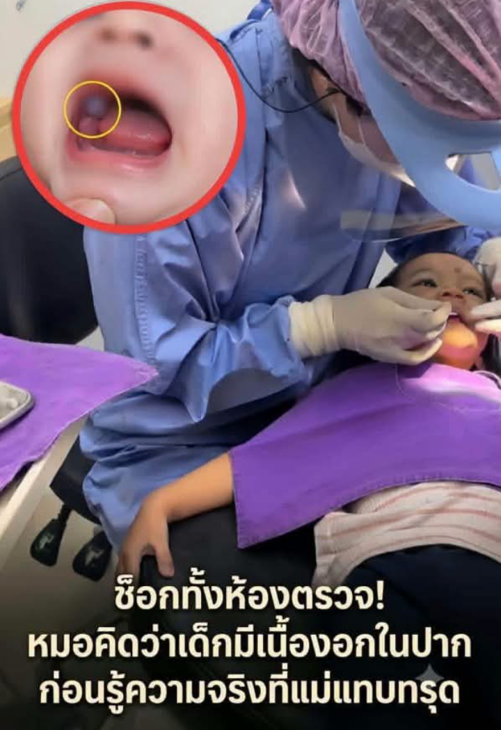 ช็อกทั้งห้องตรวจ! หมอคิดว่าเด็กมีเนื้องอกในปาก ก่อนรู้ความจริง ที่แม่แทบทรุด